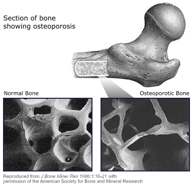osteoporosis, know your risks